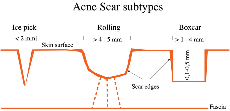 Types+of+acne+scars+pictures