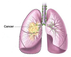 Adjuvant chemotherapy for lung cancer